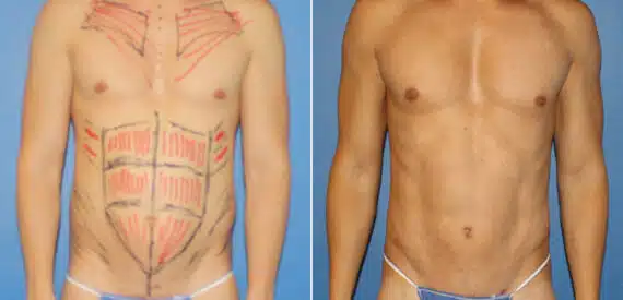 Body Banking Before and After Photos in New York, NY, Patient 16188