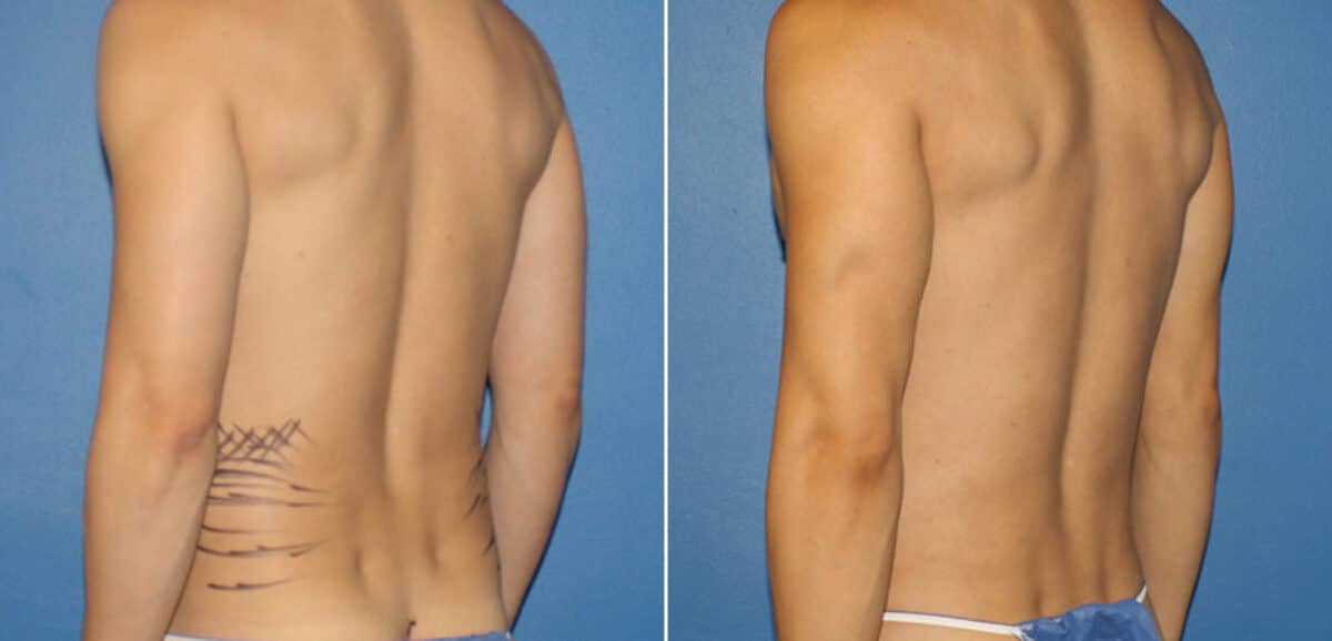 Body Banking Before and After Photos in New York, NY, Patient 16188