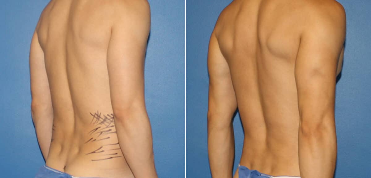 Body Banking Before and After Photos in New York, NY, Patient 16188