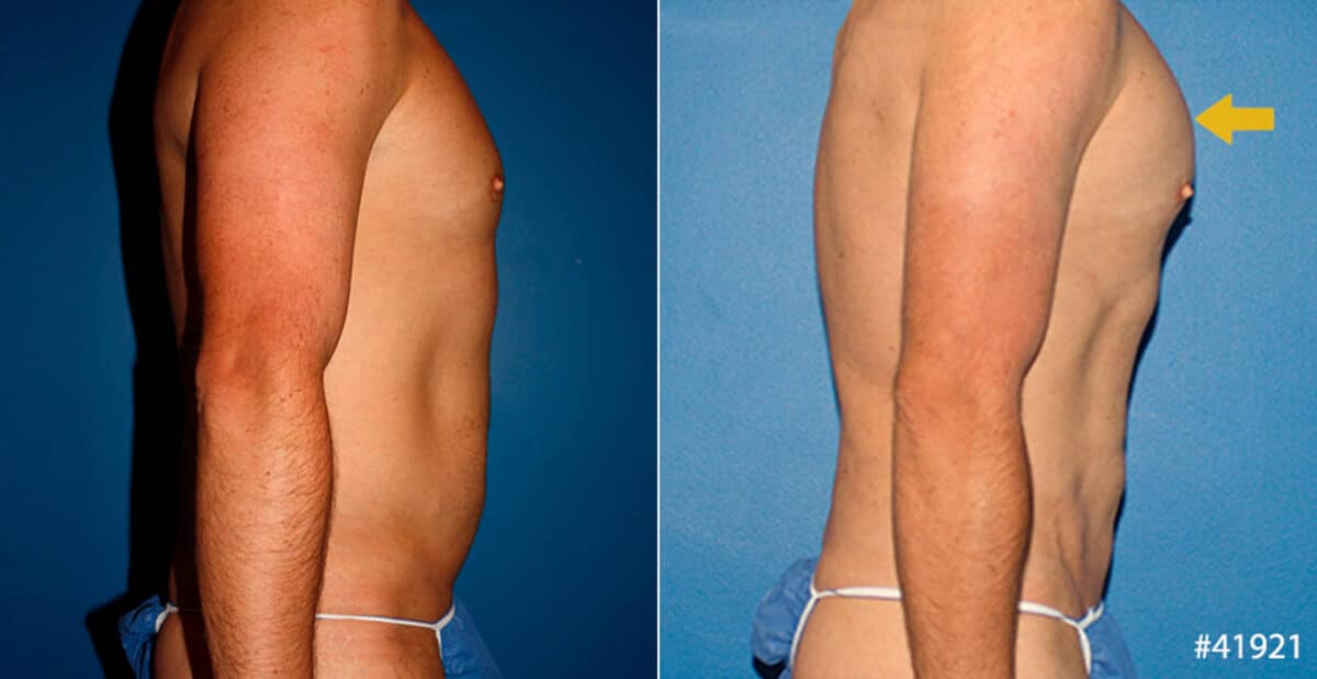 Body Banking Before and After Photos in New York, NY, Patient 16683