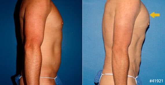 Body Banking Before and After Photos in New York, NY, Patient 16683