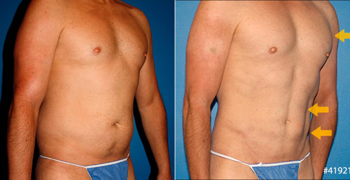 Body Banking Before and After Photos in New York, NY, Patient 16683