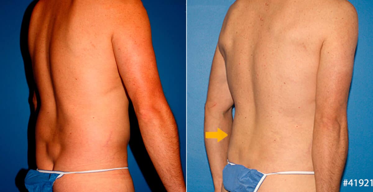 Body Banking Before and After Photos in New York, NY, Patient 16683