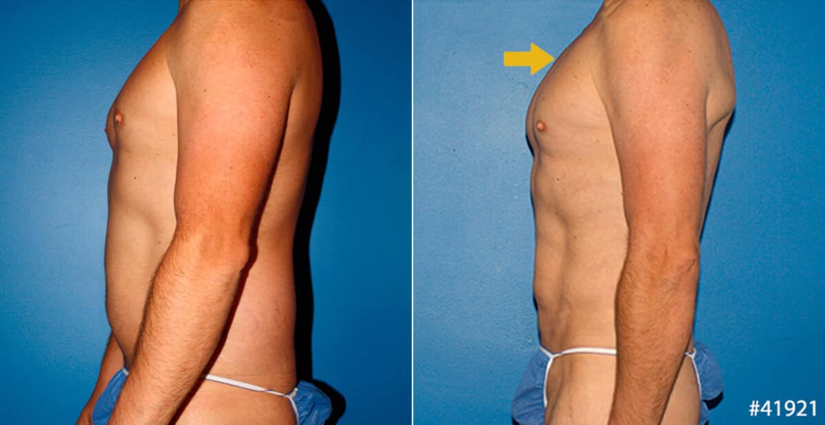 Body Banking Before and After Photos in New York, NY, Patient 16683
