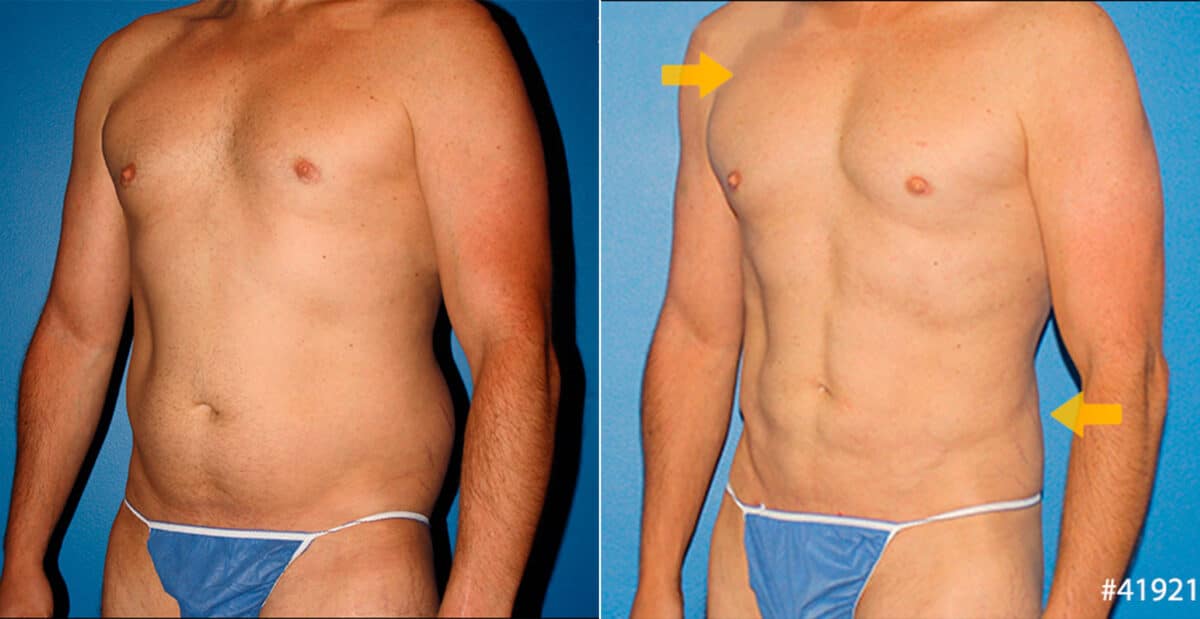 Body Banking Before and After Photos in New York, NY, Patient 16683