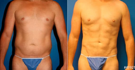 Body Banking Before and After Photos in New York, NY, Patient 16683