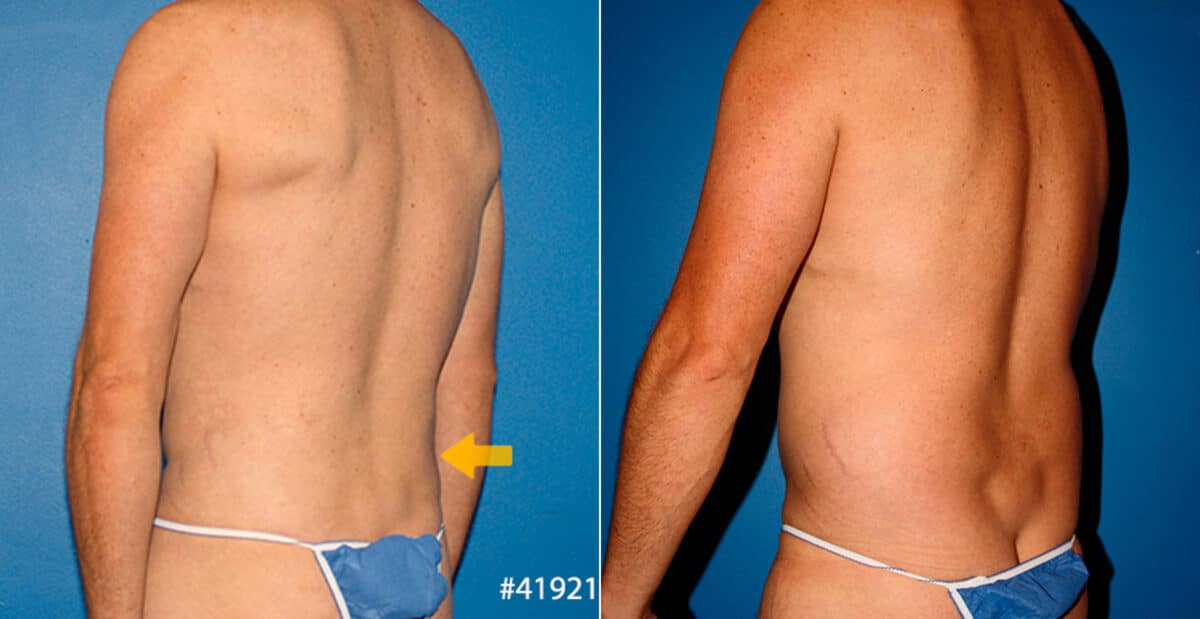 Body Banking Before and After Photos in New York, NY, Patient 16683