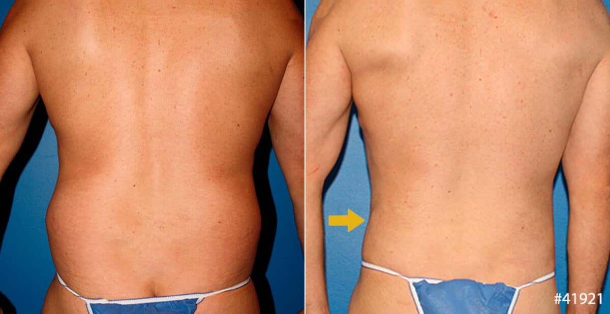 Body Banking Before and After Photos in New York, NY, Patient 16683