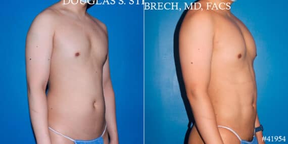 Body Banking Before and After Photos in New York, NY, Patient 17908