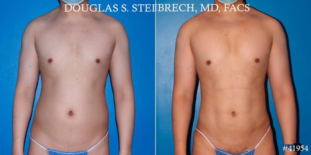 Body Banking Before and After Photos in New York, NY, Patient 17908