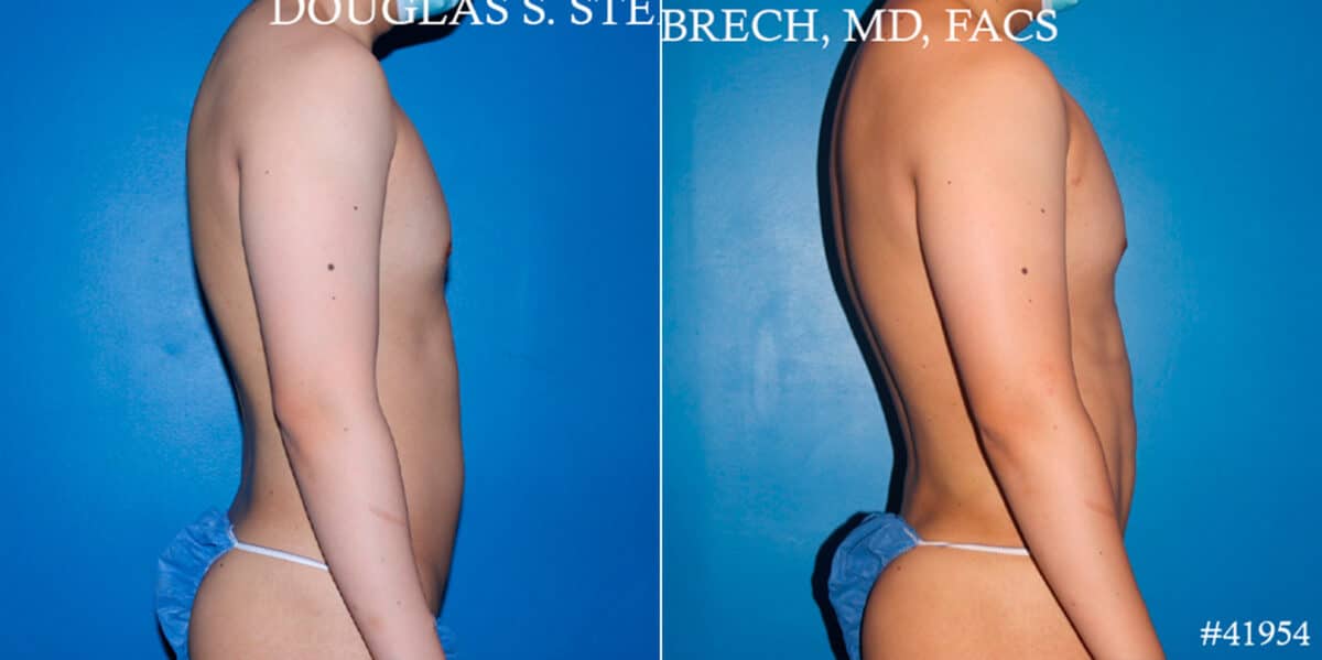 Body Banking Before and After Photos in New York, NY, Patient 17908