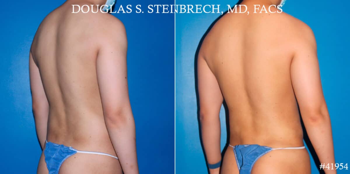 Body Banking Before and After Photos in New York, NY, Patient 17908