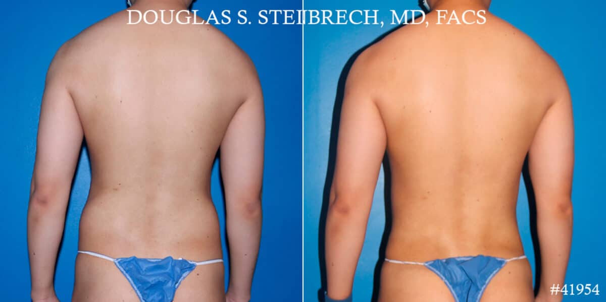 Body Banking Before and After Photos in New York, NY, Patient 17908
