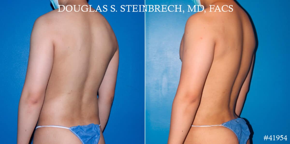Body Banking Before and After Photos in New York, NY, Patient 17908