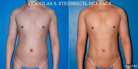 Body Banking Before and After Photos in New York, NY, Patient 17908