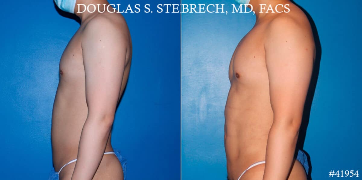 Body Banking Before and After Photos in New York, NY, Patient 17908