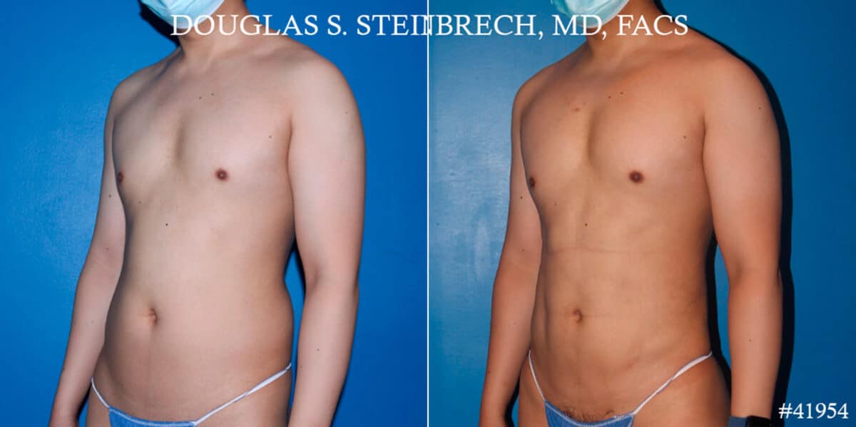 Body Banking Before and After Photos in New York, NY, Patient 17908