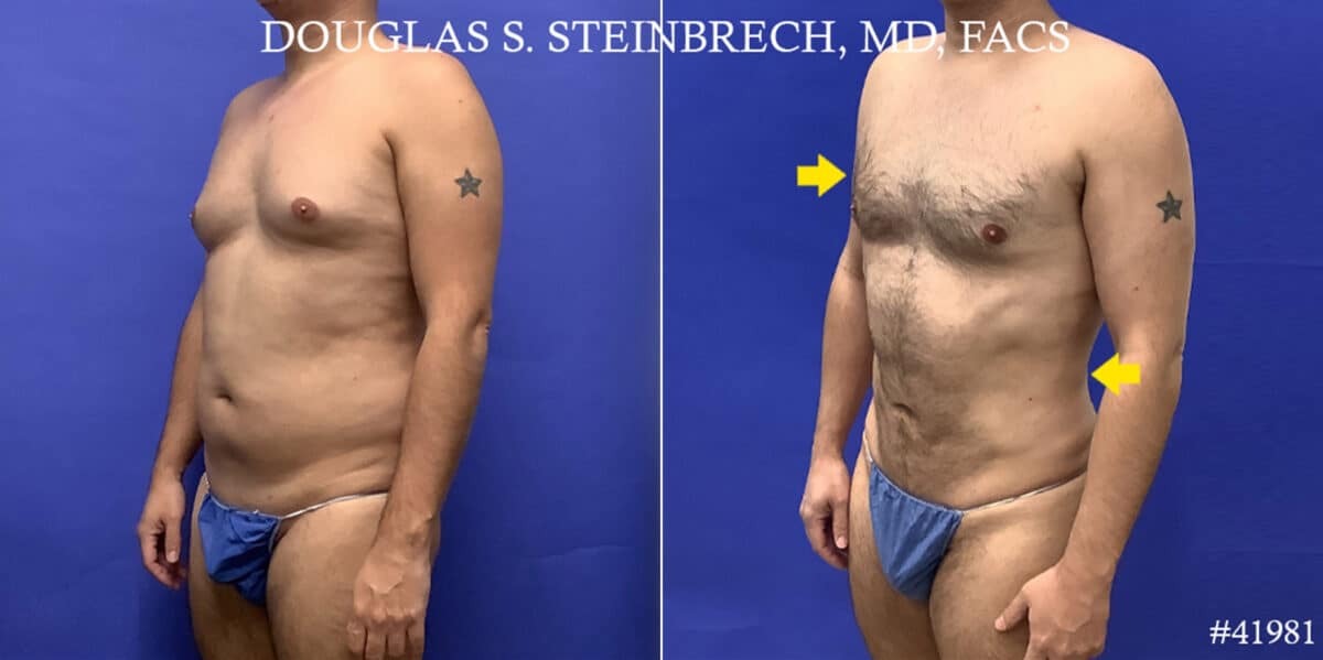 Body Banking Before and After Photos in CA, Beverly Hills, Patient 19222