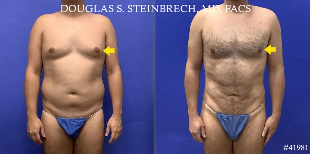 Liposuction Before and After Photos in CA, Beverly Hills, Patient 19222