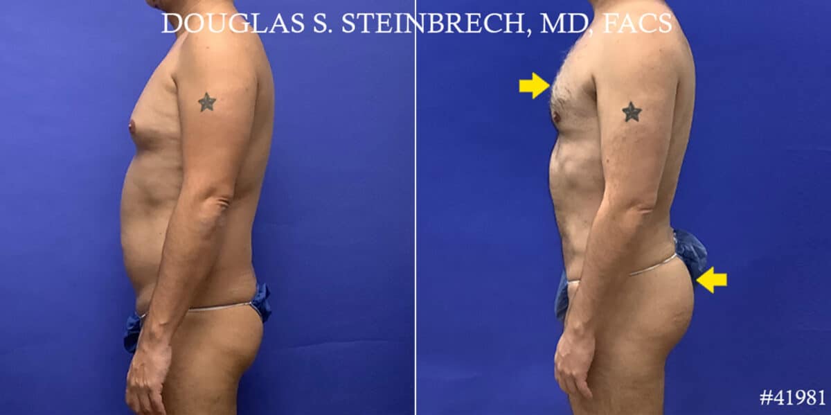 Liposuction Before and After Photos in CA, Beverly Hills, Patient 19222