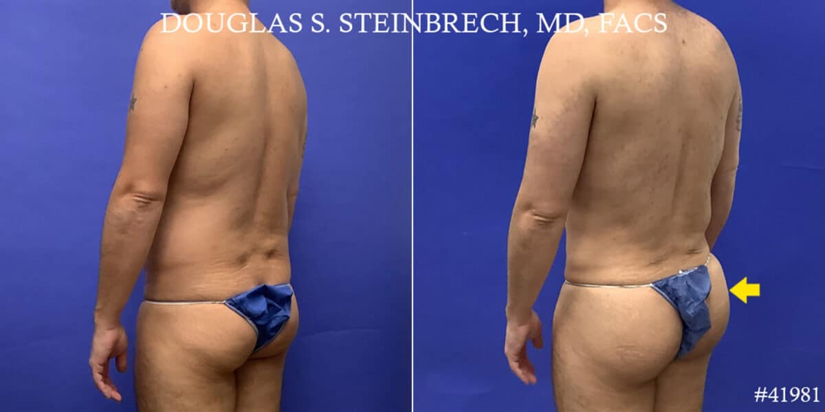 Body Banking Before and After Photos in CA, Beverly Hills, Patient 19222