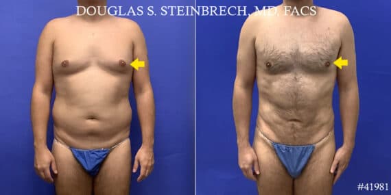 Body Banking Before and After Photos in CA, Beverly Hills, Patient 19222