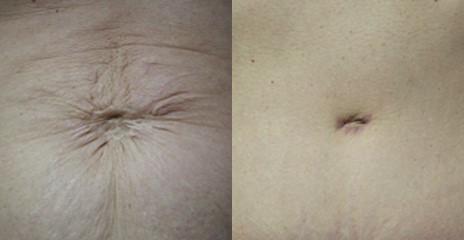 Are You Worried About Tummy Tuck Scars? Here's How Dr. Vinyard Prevents  Them!