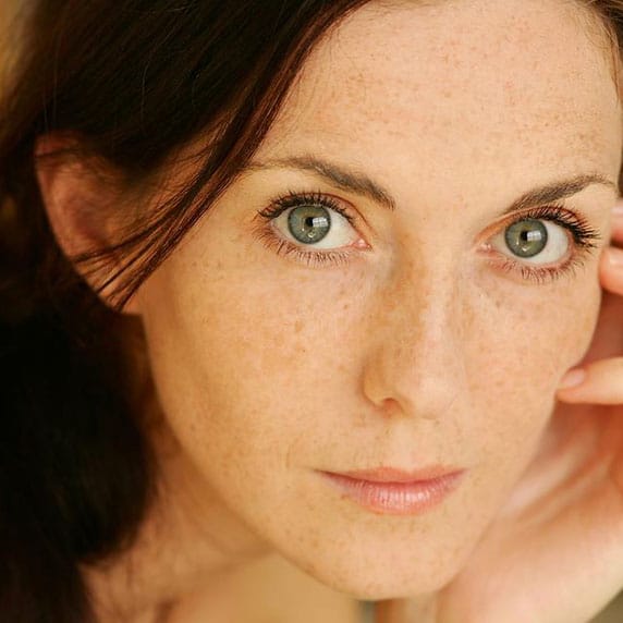 Female patient after a Ultrasound Facelift.