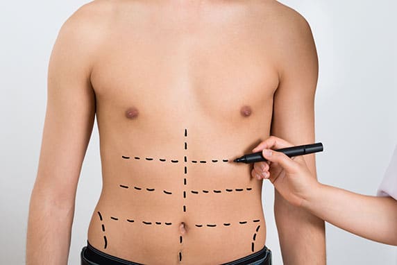 Hi Def Liposculpting for Men in New York, NY