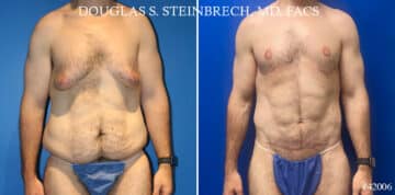 Torso Tuck Before and After Photos in New York, NY, Patient 20944