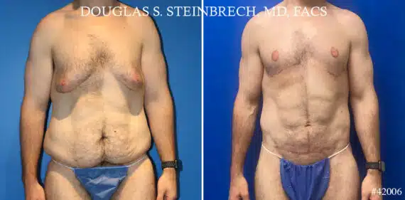 Torso Tuck Before and After Photos in New York, NY, Patient 20944