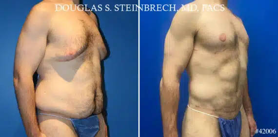 Torso Tuck Before and After Photos in New York, NY, Patient 20944