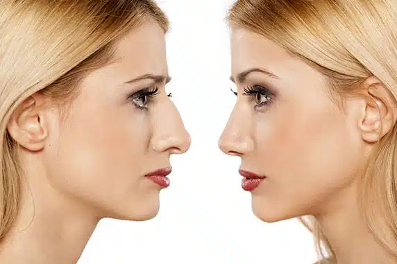 Rhinoplasty in NYC (Nose Job)