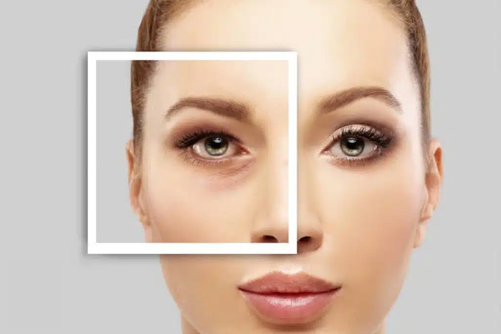 Blepharoplasty results are not immediately visible after surgery; they usually take several weeks or months for the final results to be revealed.