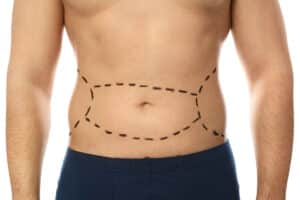 Man with marks on his abdomen in relation to a tummy tuck procedure specialized for male patients.