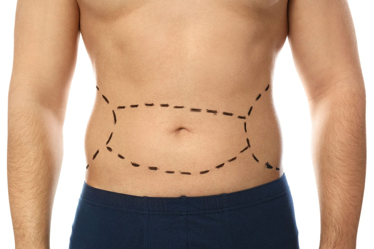 Tummy Tuck Surgery for Men: Get Your Confident Self Back