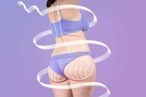 Posterior view of a female patient with marks on her glutes in a purple background in relation to a Brazilian Butt Lift procedure and how long does it lasts.