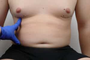 Gynecomastia is a condition that affects the breast tissue of men, causing benign enlargement of the breast area.