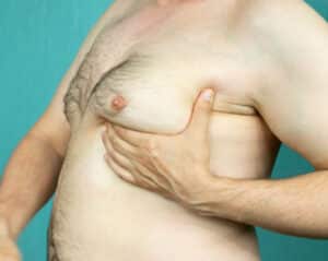 Gynecomastia is caused by a hormonal imbalance between testosterone and estrogen.