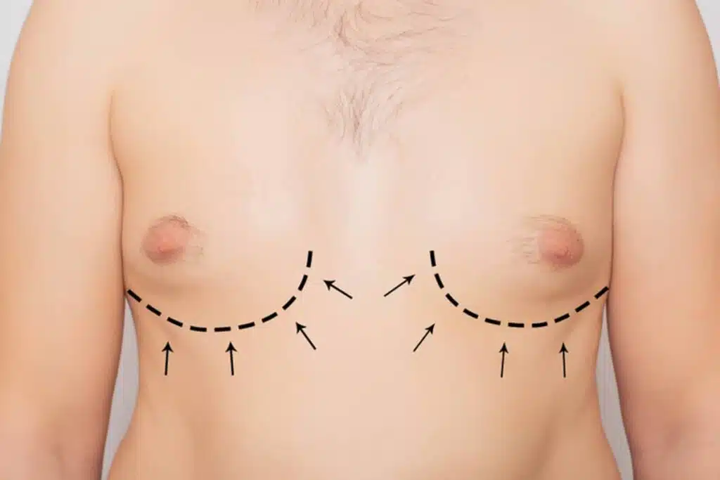 While many cases of gynecomastia go away without any intervention, some cases may require ongoing follow-up and maintenance to ensure that the condition does not return.