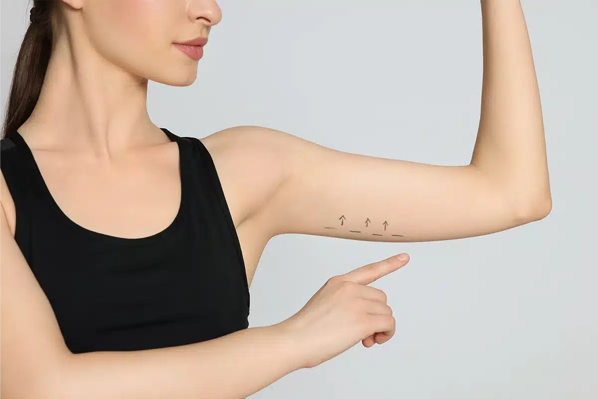 Patients can expect minimal downtime and a swift recovery process after undergoing the invisible arm lift surgery, resulting in sleeker, more youthful-looking arms.