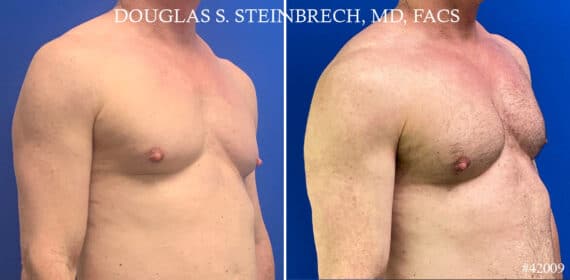 Pectoral Augmentation Before and After Photos in New York, NY, Patient 21660