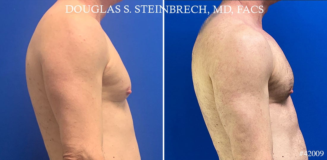 Pectoral Augmentation Before and After Photos in New York, NY, Patient 21660
