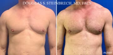 Pectoral Augmentation Before and After Photos in New York, NY, Patient 21660