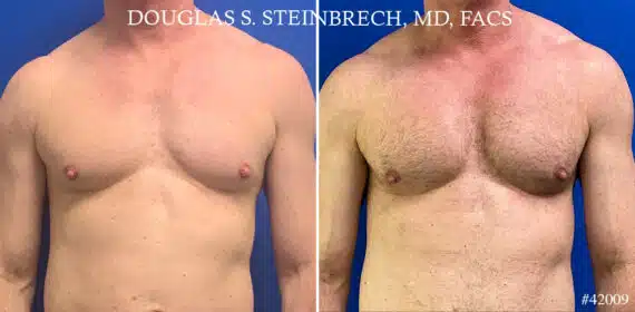 Pectoral Augmentation Before and After Photos in New York, NY, Patient 21660