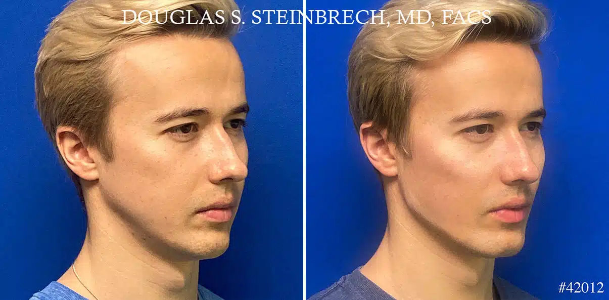 Male Model Make Over Before and After Photos in New York, NY, Patient 21671