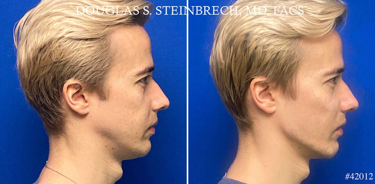 Male Model Make Over Before and After Photos in New York, NY, Patient 21671