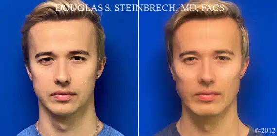 Male Model Make Over Before and After Photos in New York, NY, Patient 21671