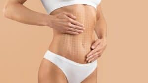 Expert abdominoplasty showing improved abdominal contour
