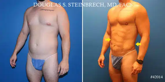 Body Banking Before and After Photos in CA, Beverly Hills, Patient 22040